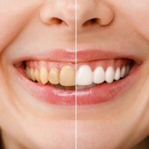 Dịch Vụ Tẩy Trắng Răng