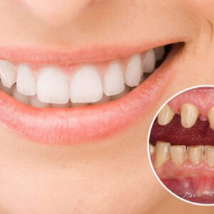 Bọc Răng Sứ Thẩm Mỹ