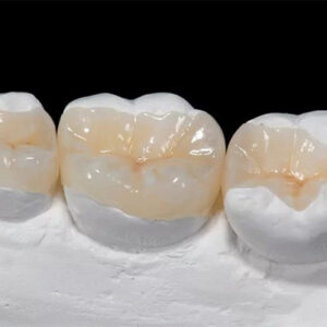 Dịch Vụ Trám Răng